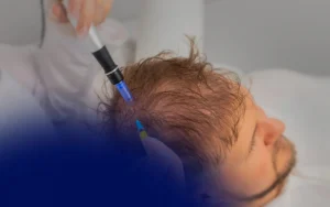 Dubai Hair Transplant Costs: FUE vs FUT vs DHI