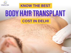 What is a Body Hair Transplant: A Comprehensive Guide