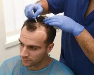 How Hair Transplant in Islamabad Can Boost Your Confidence