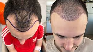 Why Men Prefer Hair Patches Over Surgery in Dubai