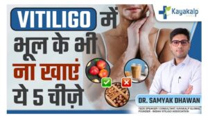 “Is It Possible for Vitiligo Not to Come Back After Recovery? | Best psoriasis treatment in India”