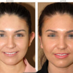 otoplasty-before-and-after-pictures-33-1.jpg