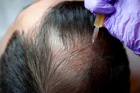 Can Acell + PRP be combined with other hair loss treatments (e.g., minoxidil, finasteride)?