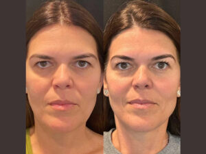Safety First: How the Best Aesthetic Clinic in Dubai Ensures a Risk-Free Thread Lift