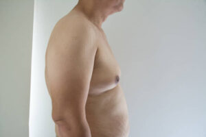 How Gynecomastia Liposuction in Riyadh Transforms Male Physique: Expert Insights
