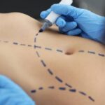 عملية-شفط-الدهون-في-الرياض-11.jpg