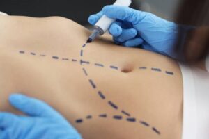 How to Choose Affordable Liposuction in Riyadh Without Compromising Quality