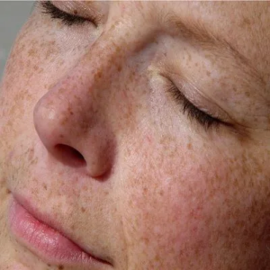 Are Dermal Pigmentation Removal Treatments Safe for the Skin?