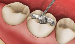 Can Antibiotics Treat Nerve Inflammation Post-Filling?