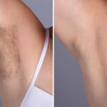 H15-Laser-Hair-Removal-1.jpg