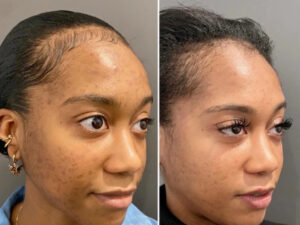 A Complete Guide to Chemical Peel at the Best Aesthetic Clinics in Dubai