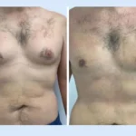 H4-Gynecomastia.webp
