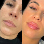 H6-lip-fillers.jpg