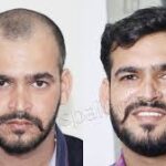 Hair-Transplant-doctor-in-Gurgaon.jpg