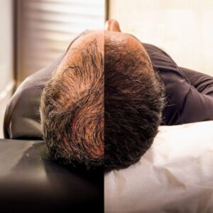 Say Goodbye to Hair Loss with Hair Transplants in Islamabad