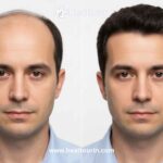 Hair-transplantation-in-India-1.jpeg