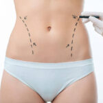 Liposuction-surgery-in-Riyadh-21.jpg