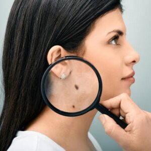 Can Mole Removal Treatments Leave Any Scars?
