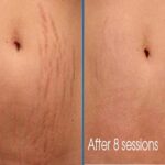 Stretch-mark-therapy.jpg