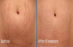 Can Stretch Marks Be Removed Without Surgery?
