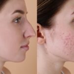 pimples-treatment-in-Islamabad-1.jpg