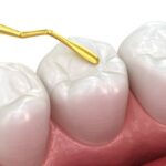 How-Are-Tooth-Colored-Fillings-Placed.jpg