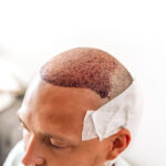How-Does-Hair-Transplant-Improve-Hair-Texture-and-Densit.jpg