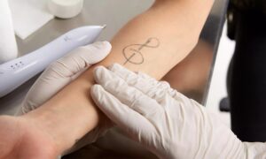 Does Laser Tattoo Removal Lighten the Skin?