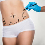 Liposuction-surgery-in-Riyadh-38.jpg