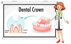Everything You Need to Know About Dental Crown Replacement