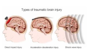 Brain Injuries Uncovered: Understanding 4 Major Categories