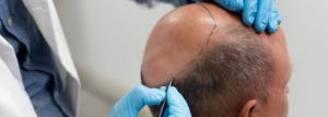 Achieve Natural Hair Growth with FUE Hair Transplant