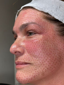 Can Plasma Pen Treatment Reduce Wrinkles Around Mouth?