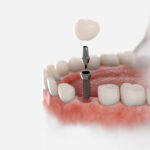Dental-Implants-Cost-in-Riyadh-22.jpg