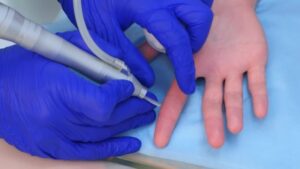 Effective Warts Treatment for All Skin Types