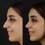 H-Rhinoplasty4-copy_11zon.jpg