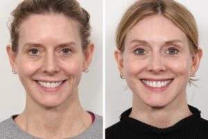 Thread lift Treatment in Dubai for Subtle Facial Enhancement