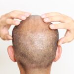 How-Does-Crown-Hair-Transplant-Prevent-Further-Baldnes.jpg