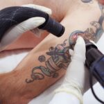 How-Safe-Is-Laser-Tattoo-Removal-for-Skin-Healin.jpg
