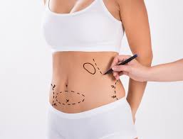 Liposuction in Islamabad: Personalized Treatment Plans