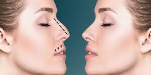 Ultimate Guide to Rhinoplasty in Riyadh for Perfect Nose Shape