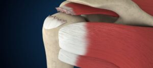 Rotator Cuff Injuries Treatment Market: Size, Trends, and Growth Forecast 2026-2033