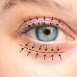 What-is-blepharoplasty-surgery.jpg