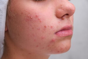Why Choose a Gentle Approach to Pimples Treatment?