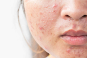 How Do Acne Treatments Work on Oily Skin?