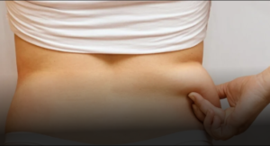 Back Liposuction in Dubai – Myths vs. Facts Explained