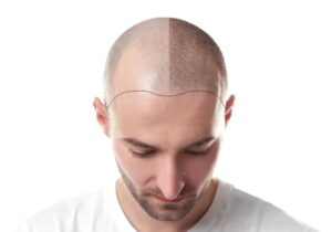 How Long Does a Hair Transplant Last?