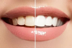 Teeth Whitening in Bowie, MD: A Smarter Way to Refresh Your Smil