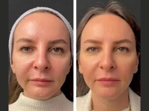 Best Plastic Surgeons in Dubai Introduce Mesotherapy for Fine Lines