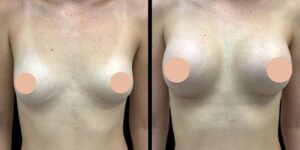 Breast Augmentation Surgery in Dubai: Pre-Surgery Preparation Tips for the Best Outcome